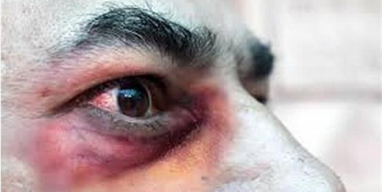 چه کار کنیم به «قارچ سیاه» مبتلا نشویم؟ چه کار کنیم به «قارچ سیاه» مبتلا نشویم؟