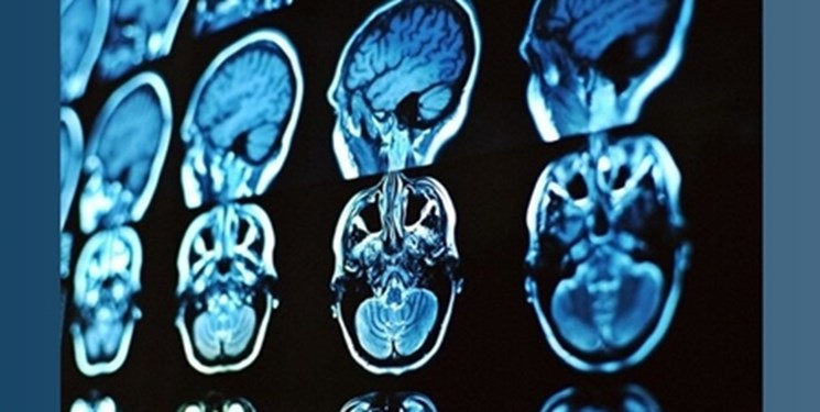 محققان برای تشخیص و درمان بیماری‌های مغزی محصولی جدید ارائه کردند