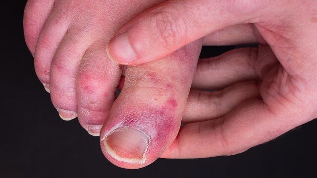 چرا برخی افراد به عارضه “انگشت پای کوویدی” مبتلا می شوند