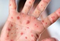 ابتلای ۹۶ نفر به سرخک در کشور/ توضیحات وزرات بهداشت در خصوص پیشگیری و مراقبت از این بیماری