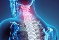 چگونه بیرون زدگی دیسک گردن را درمان کنیم؟