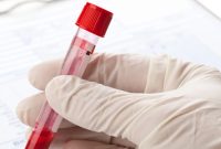 تشخیص سرطان تخمدان با یک آزمایش خون